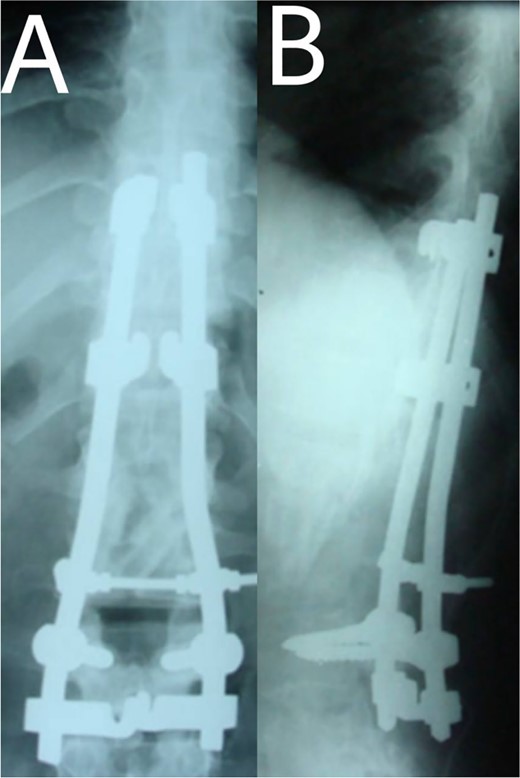(A, B) Post-operation, anteroposterior and lateral view showing fibular autograft implantation followed by supplemental posterior instrumentation.