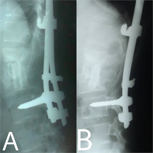 (A, B) 2, 4 months after single-stage posterior extensive debridement and fibular autograft implantation followed by supplemental posterior instrumentation performed to treat the spinal infection.