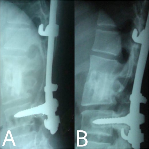 (A, B) Complete bony incorporation between the implanted fibular autograft and host vertebral body was noted on the lateral radiograph 1, and 14 years later.
