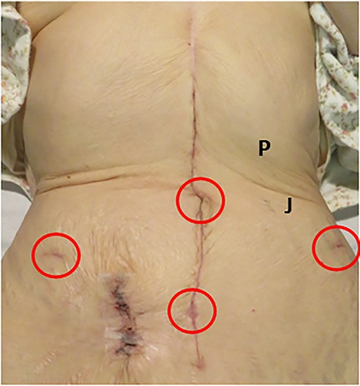 Abdomen of the patient, upper umbilicus–xiphoid process showed scarring during gastric cancer surgery. Trocars were placed in four places (red circles). Palmer’s point (P): 3 cm below the lower edge of the rib arch on the midclavicular line; Jain point (J): the left paraumbilical region 2.5 cm medially above the anterior superior iliac spine and up to the side of the navel.
