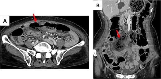 Contrast-enhanced CT on the third day after the primary operation. (A) The continuity of the transverse colon wall was interrupted. (B) Abscess formation was suspected with a surrounding stool mass.