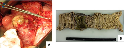 Findings on repeat surgery. (A) The wall was markedly thin, but no perforation was noted. (B) Necrotic changes were observed locally on the mucosal surface of the colon by ~5 cm.