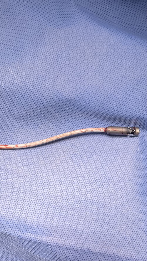 Fractured blood outlet portion and pump motor of Impella device.