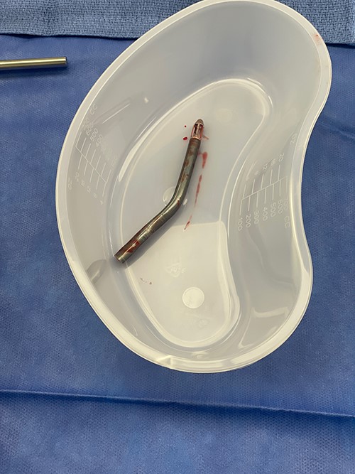 Fractured blood inlet portion of Impella device.