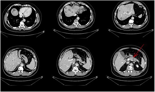 Pancreatic tail/body cancer (red arrow) with multiple liver lesions.