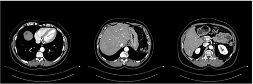 Status post-multimodal therapy with significant lesional downsizing or complete vanishing of cancerous lesions.
