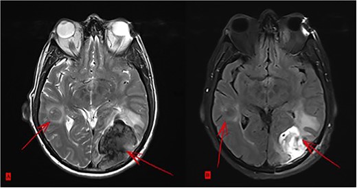 (A) Two brain metastases. (B) Status after surgical intervention on the bigger lesion.