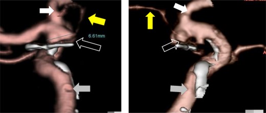 Preoperative CT angiography showed recurrent left ICA–AchA aneurysm and a surgical clip of the previous operation (open white arrow). The yellow arrow points to the AchA main trunk originating from ICA. The white and gray arrows indicate the anterior cerebral artery and ICA, respectively.