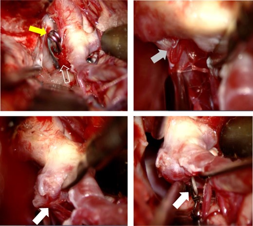 After Sylvian fissure dissection, the recurrent aneurysm (open white arrow) and the surgical clip (yellow arrow) were exposed. AchA’s main trunk (gray arrow) was detached from the aneurysm (compressed by microscissors), and the AchA main trunk was confirmed to arise from the ICA. Two small AchA branches were also found arising from the aneurysmal dome (white arrow). The two small AchA branches were temporarily occluded for 10 min.