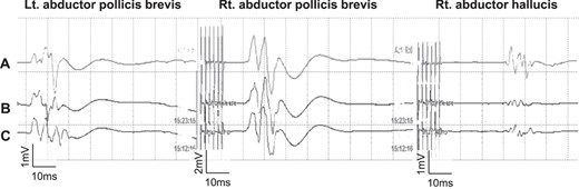 The MEP did not change even after 10 min of occlusion and until completion of skin closure. (A; after skin is closed, B: after 10 min of occlusion, C; before occlusion of Ach A branches).