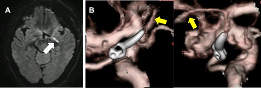 DWI-MRI revealed a new ischemic brain lesion at the uncus of the left AchA territory 1 day after surgical clipping (A). CTA demonstrated complete aneurysm obliteration and a healthy patency of the AchA main trunk (B, yellow arrow).