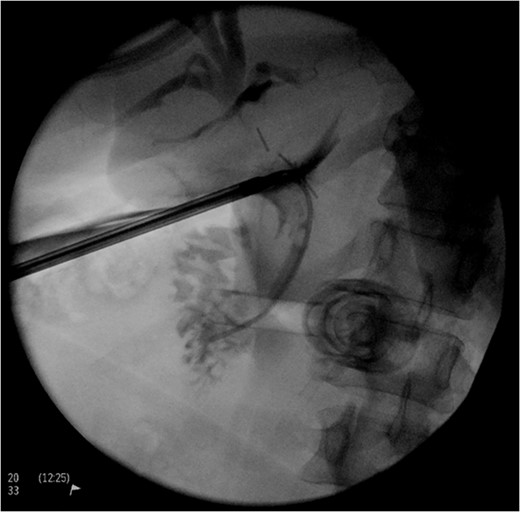 Intraoperative cholangiogram.