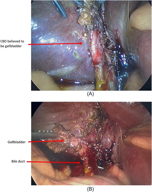 (A) Intraoperative view following cholangiogram. (B) Intraoperative view following fundus-first approach.