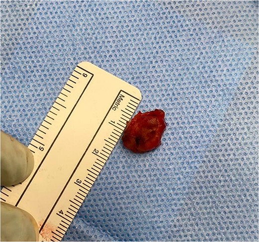 Gallbladder specimen.