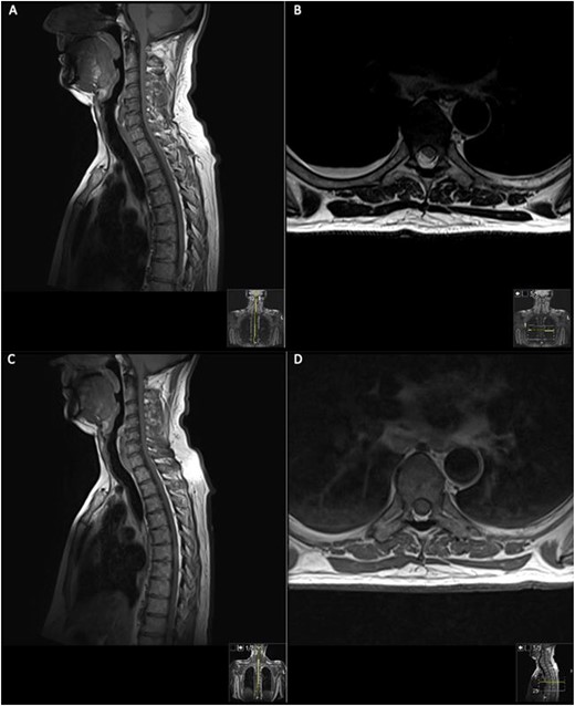 MRI on initial presentation; T1 (A) sagittal view sowing mild high signal changes alongside a T2 sequence transverse view (B) which shows the intermediate signal change; when compared with post-contrast T1 sagittal and transverse imaging (C) and (D), showing there is no significant enhancement post-contrast. MRI revealed an intramedullary spinal cord lesion at the level of T6 measuring 24 mm in craniocaudal dimension.