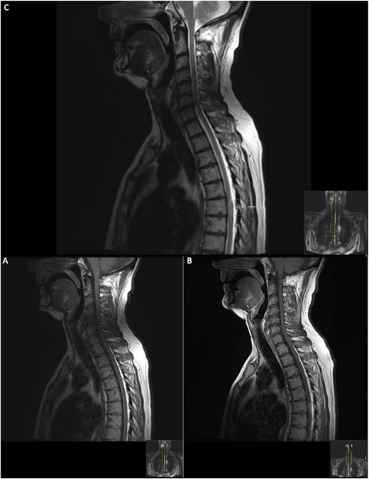 Repeat contrasted MRI whole spine; demonstrates findings consistent with spinal cord meningioma at the level of T6; this can be clearly visualized by comparing the T1 sagittal pre-contrast (A) with a T1 sagittal post-contrast (B), where a clearly demarcated lesion can be seen at the level of T6; this is supported further by the sagittal T2 image (C) shown where an ~24 mm lesion can be seen at T6.