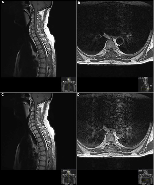 19 days post operative MRI; T1 pre-contrast sagittal (A) and T1 pre-contrast axial (B) show evidence of surgery at T6. Post-contrast T1 sagittal (C) and axial (D) show evidence of a small ‘fleck’ of dural enhancement, however, provide no evidence of any definite residual lesion.
