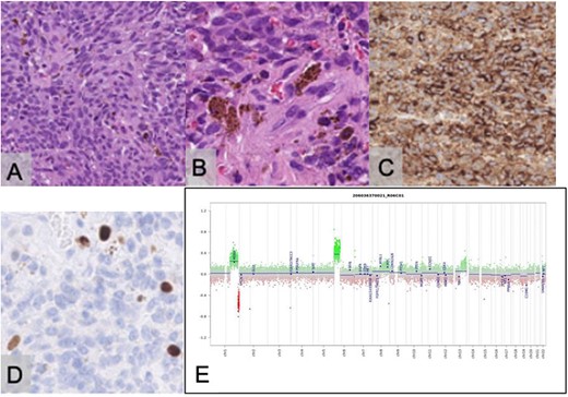 Histopathological examination with haematoxylin and eosin staining reveals a tumour with a storiform pattern (A) and widespread melanin pigment deposition (B). Immunostaining for HMB45 is positive in the tumour cells (C); the Ki67 proliferative index is estimated at 5% (D); the scale bar corresponds to 100 μm (A, C) and 50 μm (B, D); copy number assay derived from the methylation array suggests a gain of Chromosome 6p (E).
