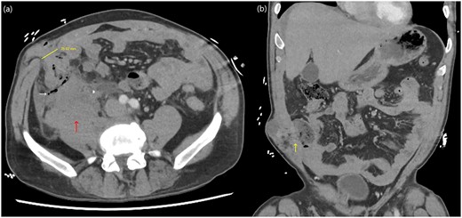 Abdominal CT axial (a) and coronal slices (b) demonstrating a 25 mm defect in the anterior abdominal wall lateral to rectus abdominis in the right lower quadrant containing caecum with adjacent small locules of extraluminal gas as well as a right-sided retroperitoneal haematoma.