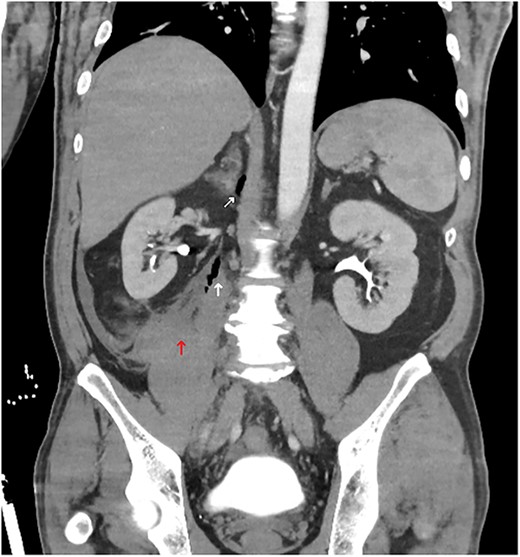 Abdominal CT coronal slice demonstrating a right-sided retroperitoneal haematoma with gas locules tracking up towards the right adrenal.