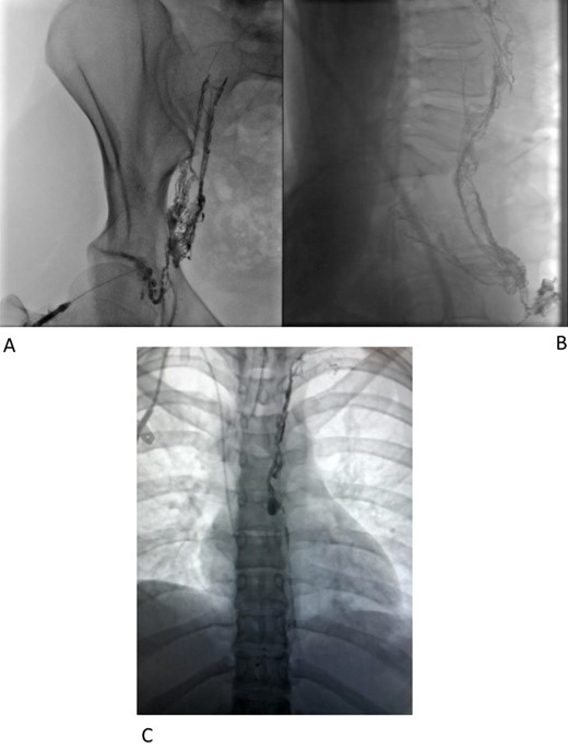 (A–C) Intranodal lymphangiogram.