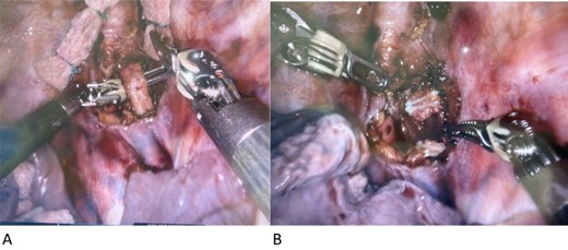 (A and B) Intraoperative left-sided thoracic duct.