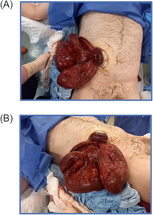 (A) Photos of eviscerated small bowel content; (B) photos of eviscerated small bowel content.