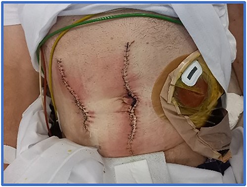 Post-operative wounds and new end ileostomy.