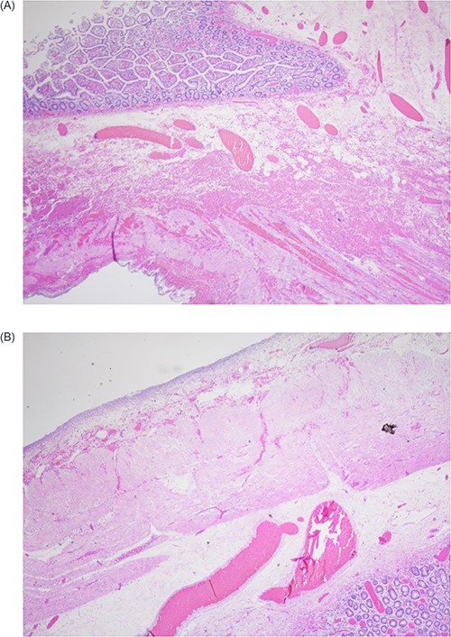(A) Histology image demonstrating marked congestion, thinning and ischaemic change of bowel wall; (B) histology image demonstrating serosal inflammation consistent with perforation.