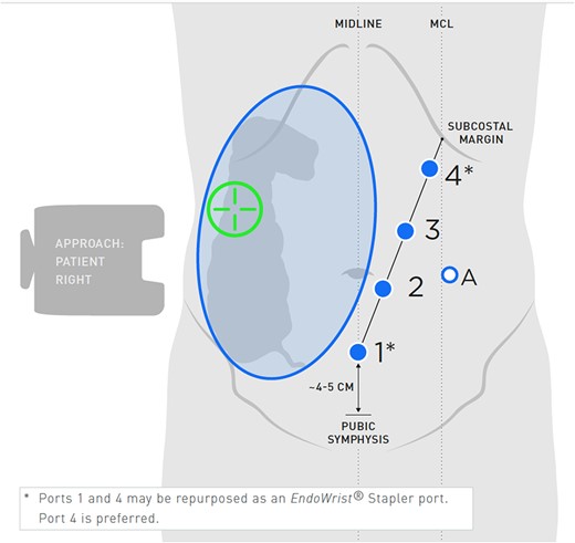 Port placement for right hemicolectomy. Adapted from: OR setup card, Intuitive Surgical Inc.