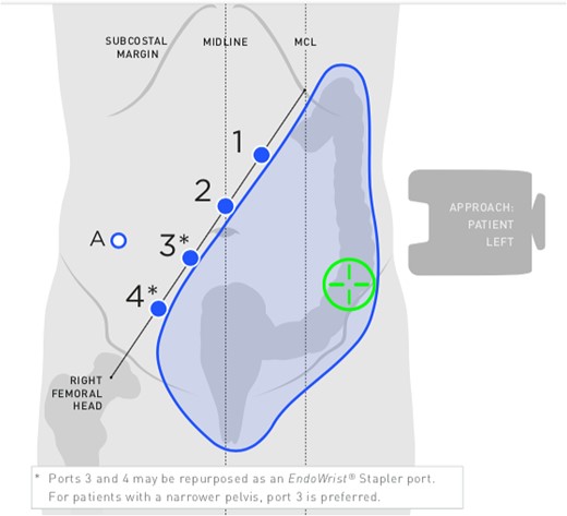 Port placement for anterior resection. Adapted from: OR setup card, Intuitive Surgical Inc.