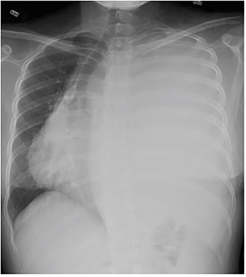 Frontal chest radiograph shows complete opacification of left hemithorax with significant mass effect.