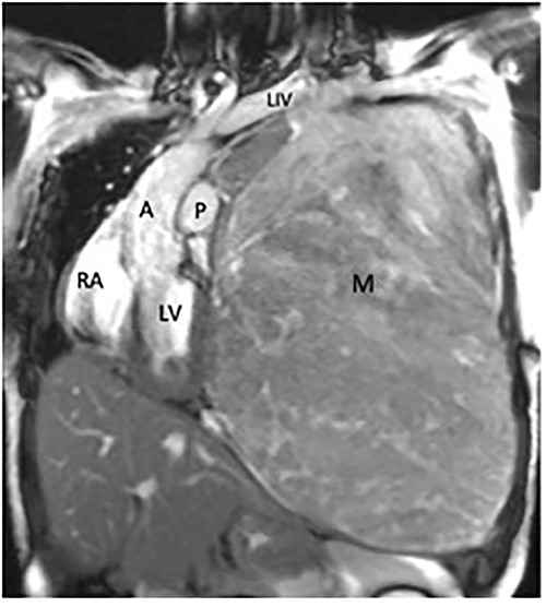 Coronal magnetic resonance image, showing the large heterogeneous mass occupying the left hemithorax. Note severe displacement of the heart and vasculature as well as complete atelectasis of the lung (L), left ventricle (LV), right atrium (RA), aorta (A), pulmonary trunk (P).