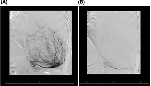 (A) Conventional angiogram engaging the left inferior phrenic artery, which perfuses much of the mass. (B) Postembolization results, demonstrating marked decrease in the mass blood supply.