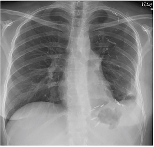 Frontal chest radiograph 2 months after resection with near-complete left lung expansion.