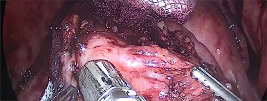 Gastric pouch, remaining stomach and gastrojejunostomy.