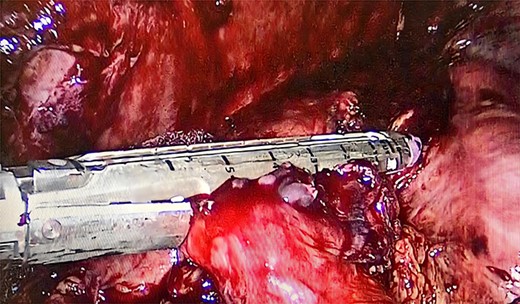 Gastrogastric anastomosis and upper dome closure.