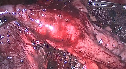 Jejunojejunal anastomosis.