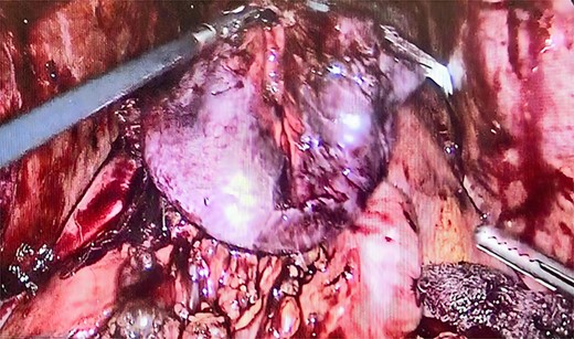 Resection of gastroileal anastomosis.