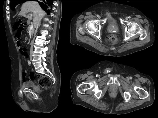 Sagittal and axial CT images demonstrating right-sided inguinal bladder hernia containing radio-opaque bladder calculi.