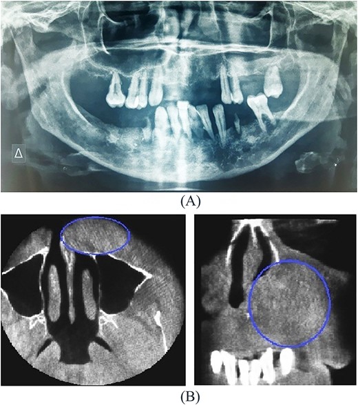(A) Orthopantomogram, (B) CBCT imaging of soft tissue mass.