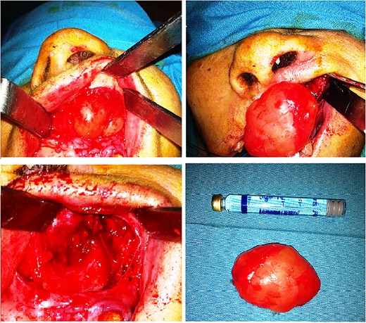 Surgical approach- enucleation, surgical specimen.