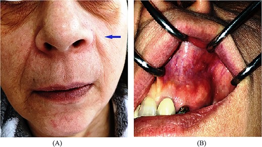 (A) Extraoral, (B) intraoral pre-operative clinical presentation of patient (case 2).