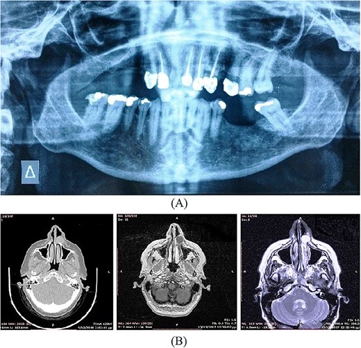 (A) Orthopantomogram (B) CT, MRI image of the lesion.