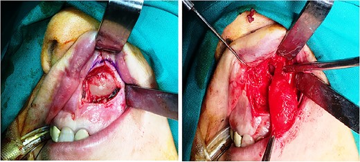Surgical approach-enucleation.