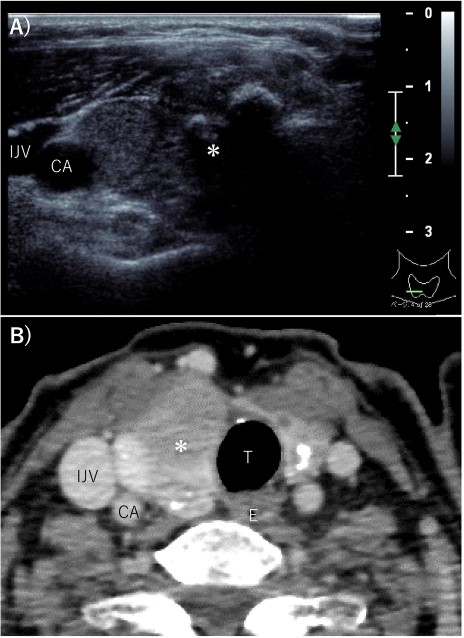 Pre-operative imaging findings of papillary thyroid cancer. (A) Ultrasonography revealed a hypoechoic 28-mm mass with internal calcification was found in the right lobe of the thyroid gland. (B) Contrast-enhanced CT revealed a 37 mm× 25 mm tumor in the right lobe of the thyroid gland without surrounding invasion and no lymph node metastasis or distant metastasis. *: tumor, CA: carotid artery, IJV: internal jugular vein, T: trachea, E: esophagus.
