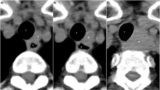CT findings of left III lymph node metastasis. (A) 4 years after initial surgery, size: 9 mm × 7 mm. (B) 5 years after initial surgery, size: 14 mm × 10 mm. (C) 7 years after initial surgery, size: 32 mm × 27 mm. *: left III lymph node, T: trachea, E: esophagus.