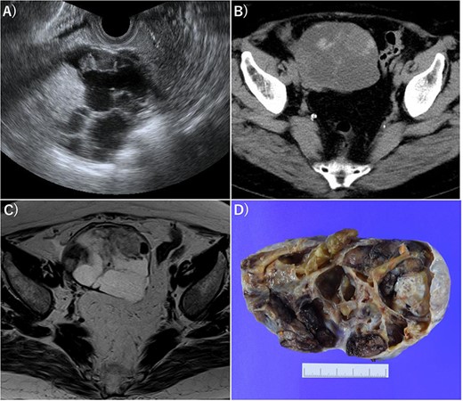Imaging of OG. (A) Transvaginal ultrasonography showed numerous separate structures and substantial nodules. (B) CT showed a 10.5-cm multifocal cystic tumor on the right side of the uterus. (C) Magnetic resonance imaging (T2-weighted image) revealed a tumor with numerous separate structures and substantial nodules, which led to speculations that the cystic area was serous. Right ovarian cancer was suspected. (D) Gross examination also showed numerous separate structures and substantial nodules.