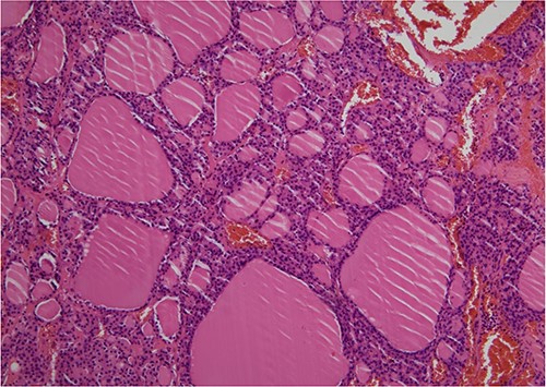 Pathological diagnosis of OG was established (HE, ×100). Histologically, the right ovarian tumor showed large and small thyroid follicles with colloid, no papillary thyroid carcinoma nuclei and no malignant findings.