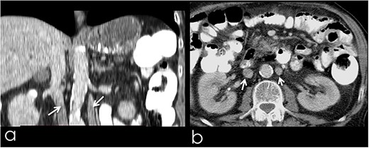 (a) Coronal image from CT with contrast, presenting the duplicated IVC (arrows); (b) transverse image from CT with contrast, presenting the duplicated IVC (arrows).